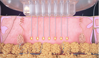 Matrix Pro® ապլիկատոր