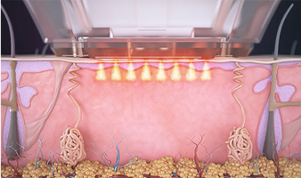 Sublative™ RF ապլիկատոր